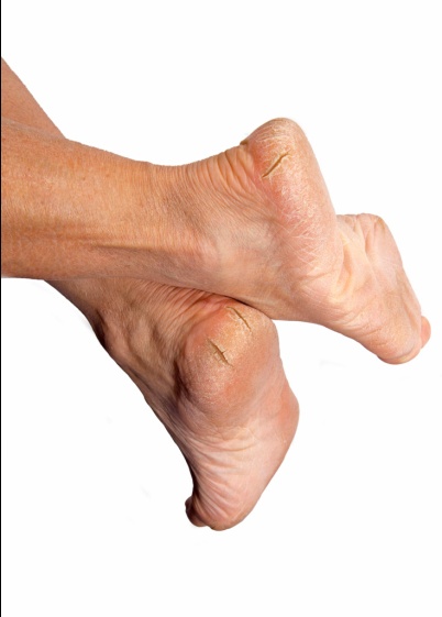 Common Causes for Foot Ulcer - Carolina Regional Orthopedics
